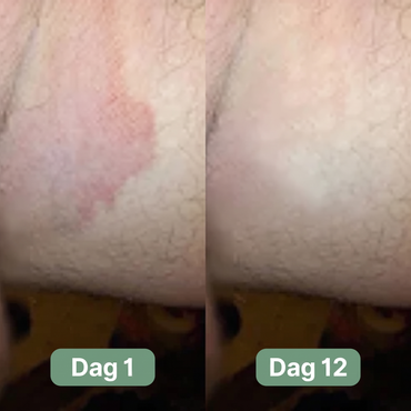 Nordic SkinBalance™ – Dyprensende kroppsbar for svetteutsatte hudområder
