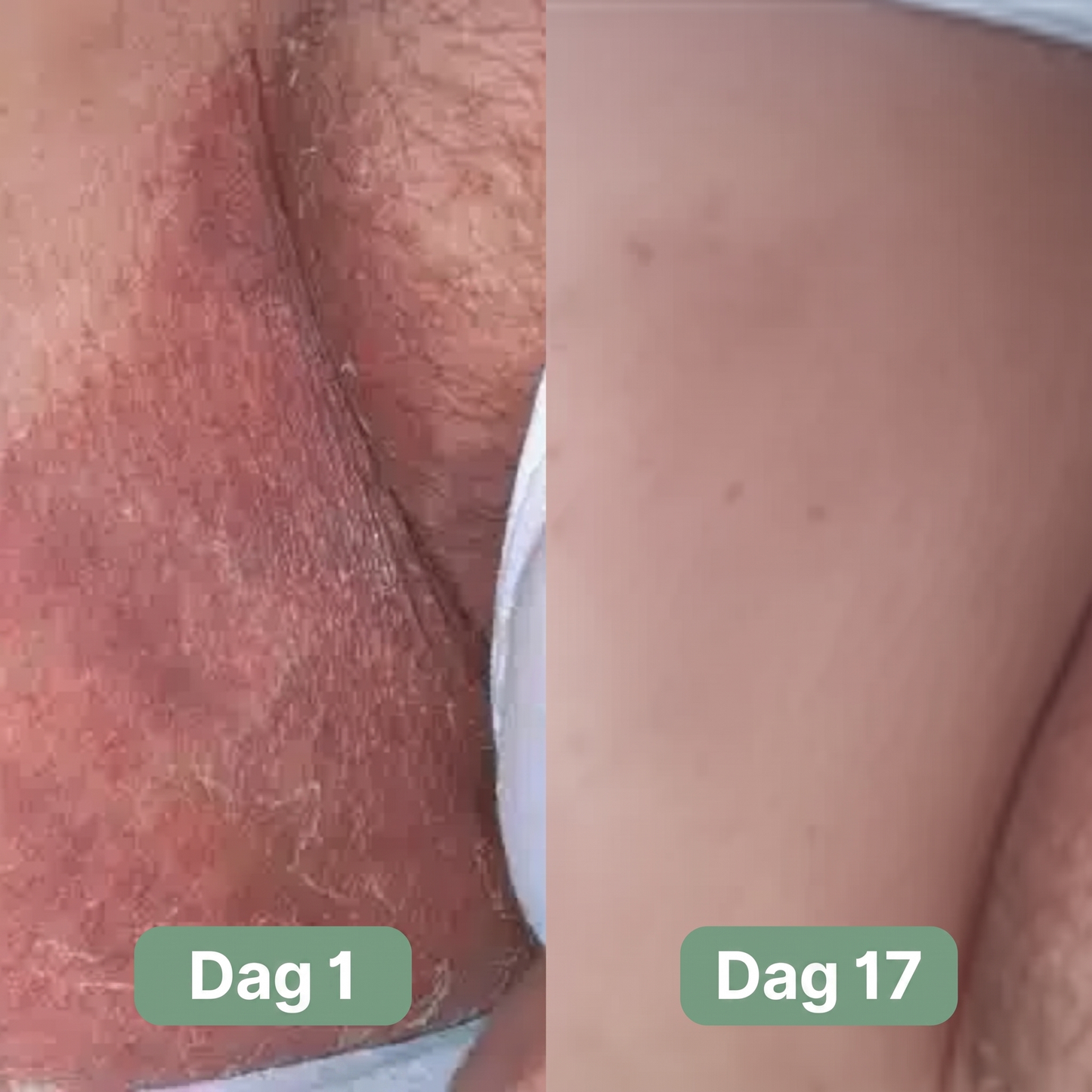 Nordic SkinBalance™ – Dyprensende kroppsbar for svetteutsatte hudområder