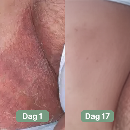 Nordic SkinBalance™ – Dyprensende kroppsbar for svetteutsatte hudområder